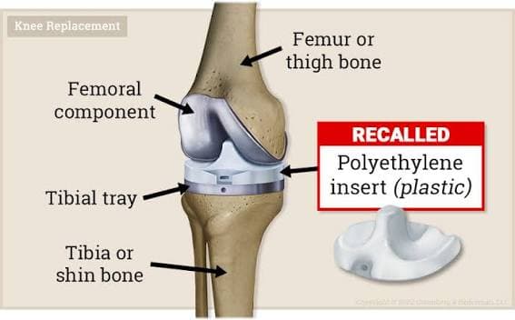 Labeled diagram of a knee replacement implant, showing the femoral component, tibial tray, and the recalled polyethylene tibial insert.